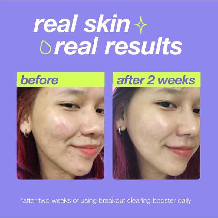 Dermalogica Clear Start Booster Set 207 ml hudplejesæt viser før og efter resultater på uren hud efter to ugers brug.